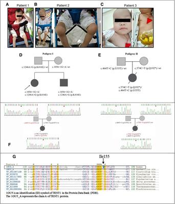 Case report: Sideroblastic anemia with B-cell immunodeficiency, periodic fevers, and developmental delay: Three cases and a literature review